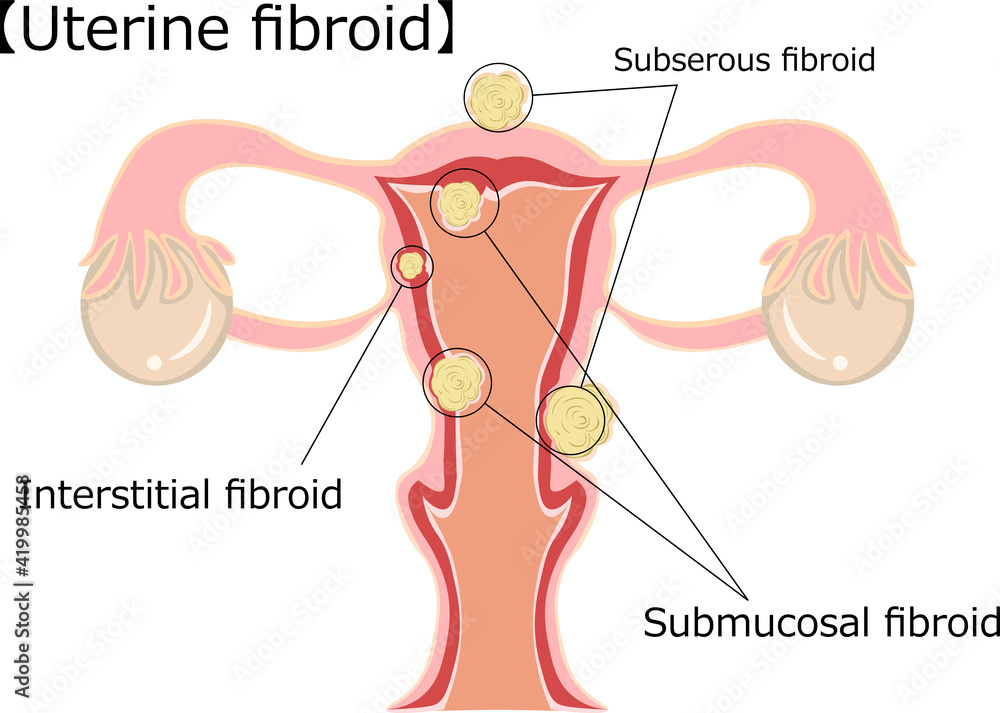 Obraz premium 子宮筋腫 イラスト