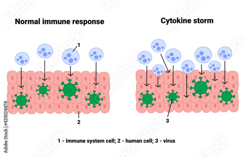 Cytokine storm in coronavirus COVID-19. Excessive Pro-Inflammatory Signaling Molecule and Self-Destruction of the Body. Hypercytokinemia. Vector medical illustration