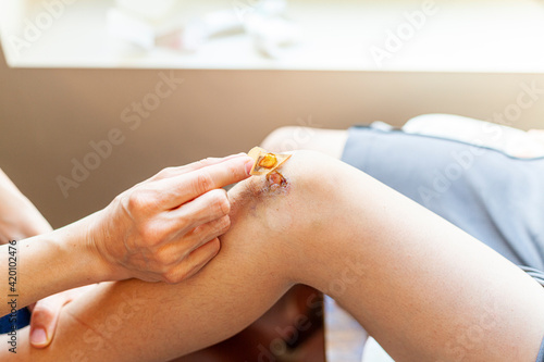 A mother is removing old adhesive bandage antiseptic from the bruised skin over the knee cap of her son. The bruised area has inflammation, tenderness and pus. She will apply cream and replace bandage