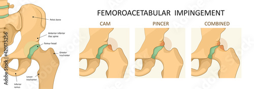 Femoroacetabular impingement (FAI). Front view of hip joint with section of the pelvis. Human skeleton, medicine.
