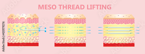 illustration of meso threads lifting