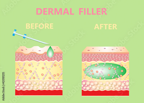 Cosmetic filler or dermal fillers