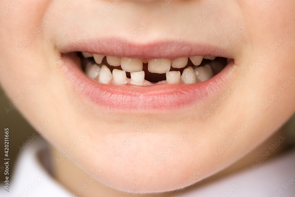 The smile of a five and a half year old boy whose first milk tooth and lower incisor fell out The smile of a five and a half year old boy whose first milk tooth and lower incisor fell out
