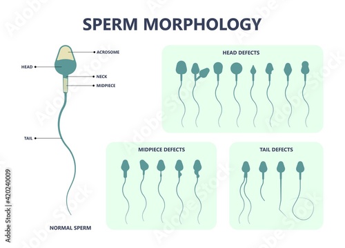 in vitro fertilization IVF semen test sample sperm count type Male biopsy fertility collect Low Poor Zero head anatomy midpiece tail birth control blocked defect abnormal ejaculate vas Non dry photo