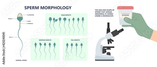 in vitro fertilization IVF semen test sample sperm count type Male biopsy fertility collect Low Poor Zero head anatomy midpiece tail birth control blocked defect abnormal ejaculate vas Non dry