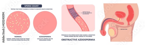in vitro fertilization IVF semen test sample sperm count type Male biopsy fertility collect Low Poor Zero head anatomy midpiece tail birth control blocked defect abnormal ejaculate vas Non dry
