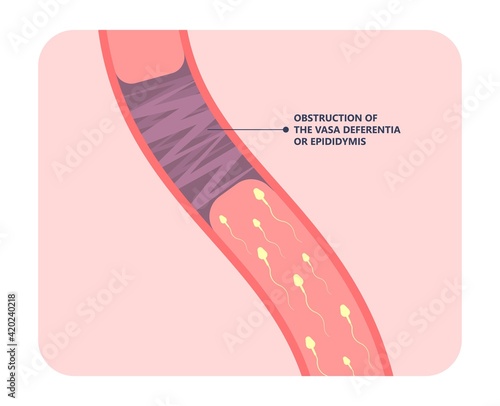 in vitro fertilization IVF semen test sample sperm count type Male biopsy fertility collect Low Poor Zero head anatomy midpiece tail birth control blocked defect abnormal ejaculate vas Non dry