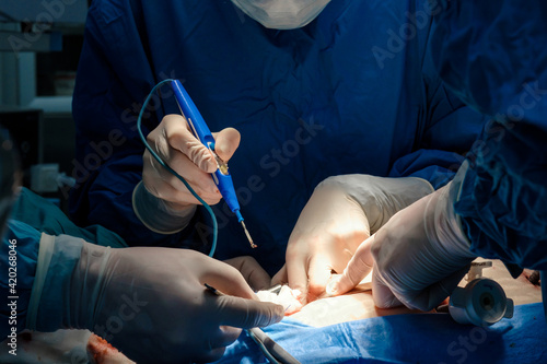 The surgeon holds the electrical coagulator during the operation. Close-up of hands in sterile gloves stained with blood. Blue uniform and medical masks.