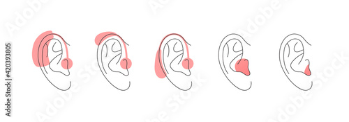 Deaf and hear aid concept. Vector flat illustration set. Collection of hearing aid device in outline human ear silhouette isolated on white. Design element for medicine, health care.
