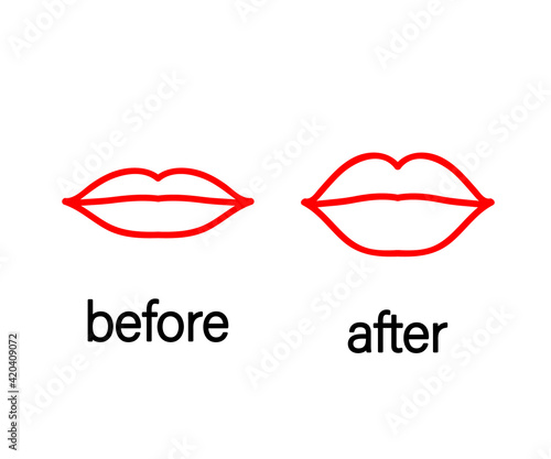 Lips before and after botox injection. Symbol. Vector illustration.