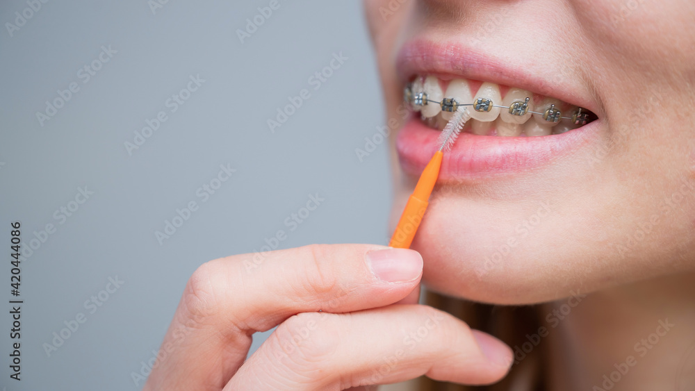 Unrecognizable Caucasian woman cleans braces with a brush. Close-up of female teeth with brackets Unrecognizable Caucasian woman cleans braces with a brush. Close-up of female teeth with brackets