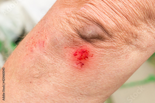 Damaged or torn wound to the elbow with the blood of an elderly person, close-up