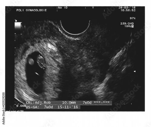 Early pregnancy viability scan photo