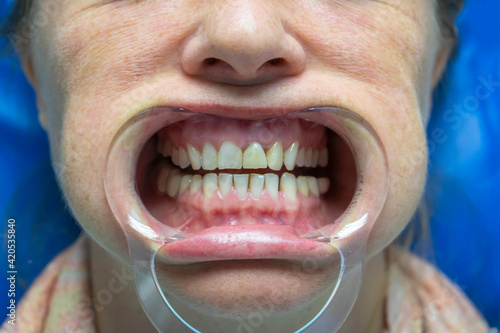 Patient woman at the dentist's appointment. Examination of teeth and oral cavity for treatment.