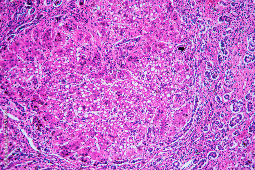 ill human liver cells of biliary cirrhosis