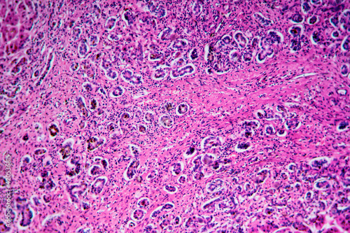 ill human liver cells of biliary cirrhosis