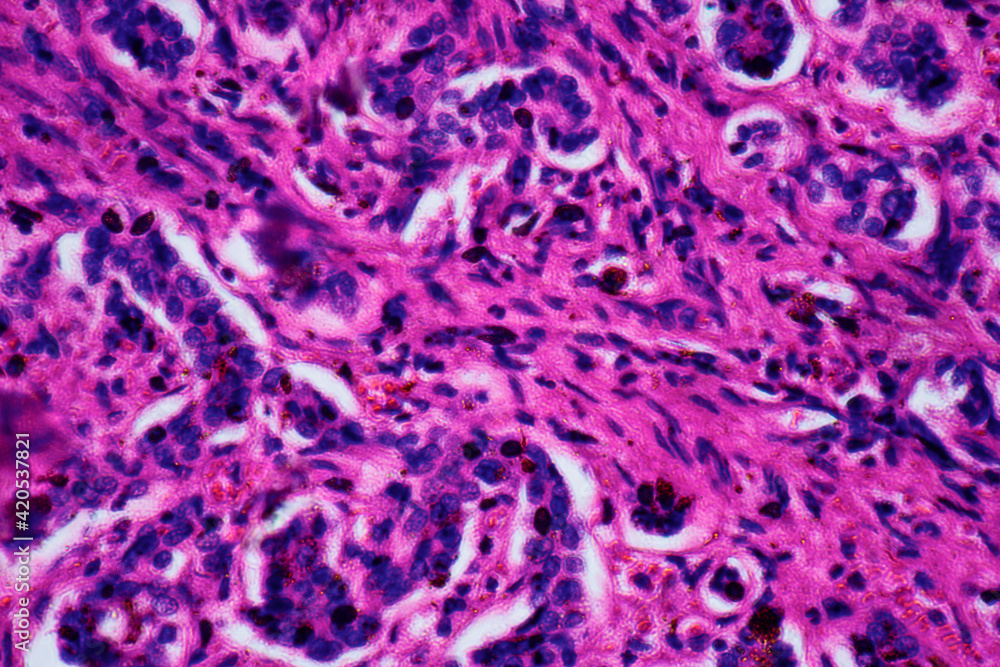 ill human liver cells of biliary cirrhosis ill human liver cells of biliary cirrhosis