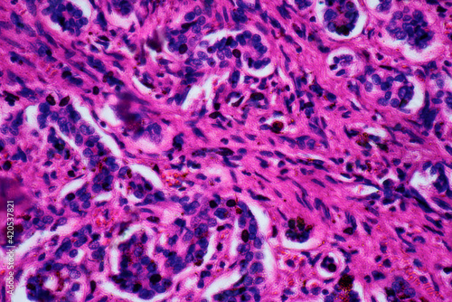 ill human liver cells of biliary cirrhosis