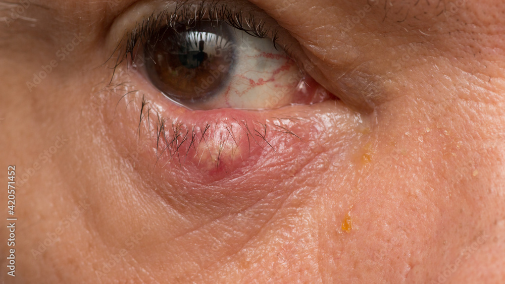 Man with a huge stye on his eyelid Man with a huge stye on his eyelid