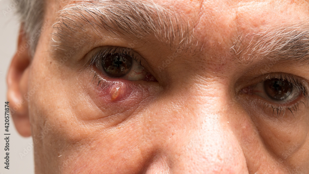 Man with a huge stye on his eyelid Man with a huge stye on his eyelid