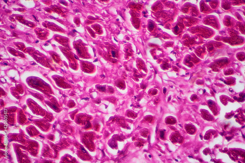 Rheumatic endocarditis human cells micrograph photo