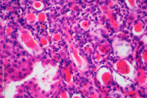 kidney of patient with hypertension