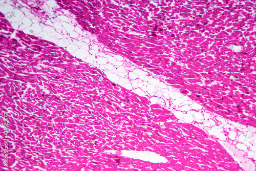 Rheumatic endocarditis human cells micrograph