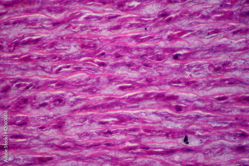 Main artery atherosclerosis human cells photo