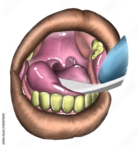 The test of uvular deviation casued by rigth vagus nerve palsy.