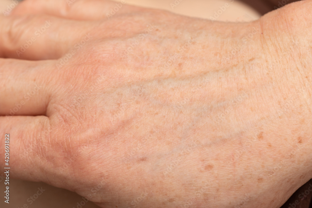 veins on the skin of the hands