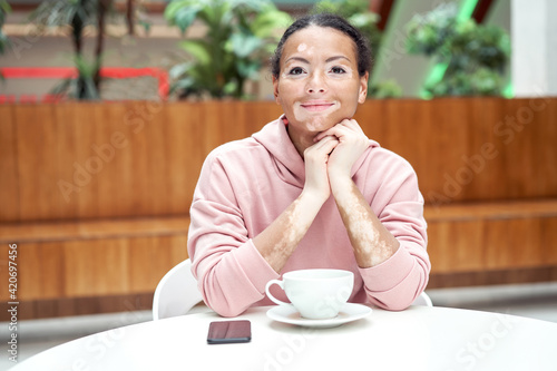 Black african american woman with vitiligo pigmentation skin problem indoor dressed pink hoodie