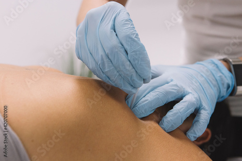 Physiotherapist puncturing a needle on a dry needling therapy