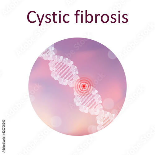 Cystic fibrosis. Genetic. DNA double helix. Medical illustration.
