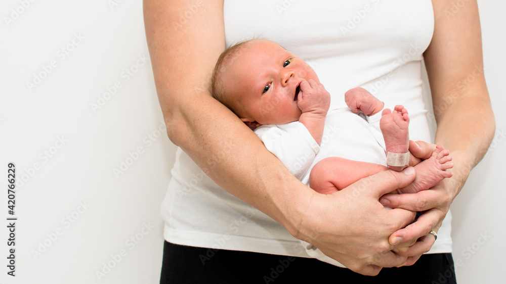 Neonatal jaundice yellowish discoloration of the white part of the