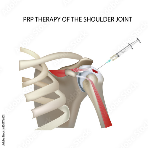 PRP therapy of the shoulder joint, vector medical illustration