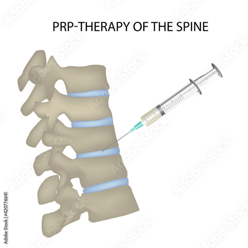 PRP spine therapy, vector medical illustration