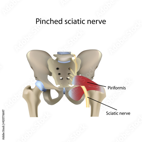 Pinched sciatic nerve, vector medical illustration