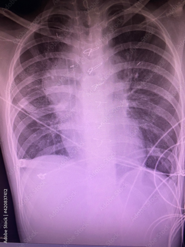 Film Chest Xray show widening mediastinum impressions of anterior