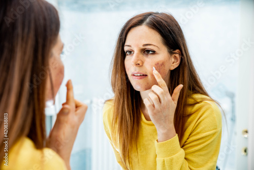 Young woman with problem skin applying treatment cream at home - Concept about skin care photo