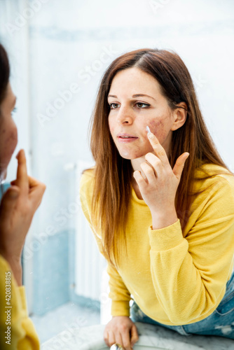 Young woman with problem skin applying treatment cream at home - Concept about skin care photo