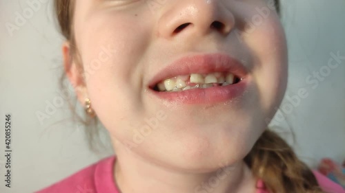 Little girl child wobbling her baby tooth