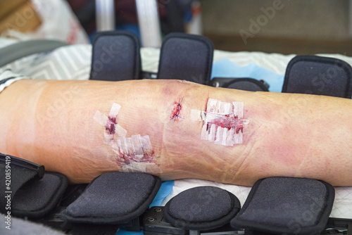 Knee After ACL and MCL Reconstruction Surgery photo