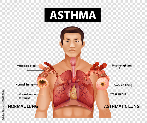 Diagram showing Asthma on transparent background