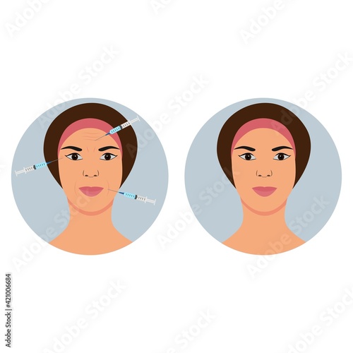 Facial injections against wrinkles and aging.Before and after.Beauty, cosmetology, anti-aging concept. Female rejuvenating mesotherapy.Vector illustration