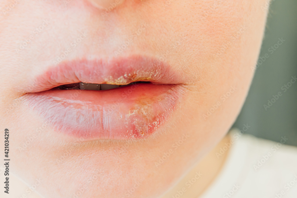 Fototapeta premium Close up of girl lips affected by herpes. Treatment of herpes infection and virus. Part of young woman face, lips with herpes affected. Beauty dermatology concept.
