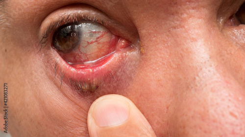 Man with a huge stye on his lower right eyelid