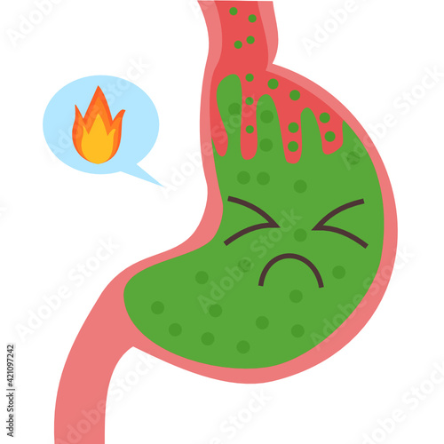 Gastroesophageal reflux disease.Stomach and gerd.Acid reflux and heartburn. photo