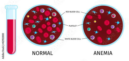 Blood Cells Anemia Chart