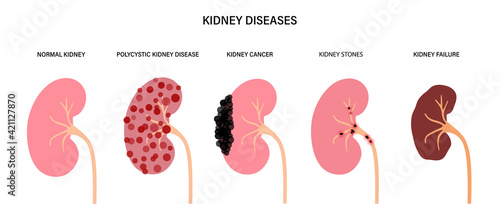 Kidney disease concept