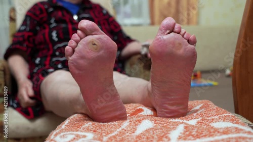 Treatment of diabetic foot ulcer. Old woman feet damage. Blood glucose intolerance problem. Foot callus